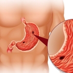 Mide Ekşimesine Ne İyi Gelir? Mide Ekşimesi Neden Olur?
