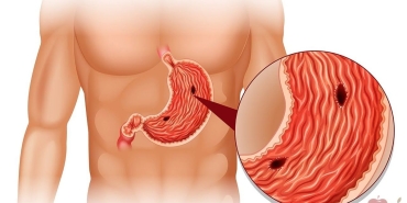mide-eksimesine-ne-iyi-gelir-mide-eksimesi-neden-olur