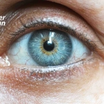 Sarı Nokta Hastalığı