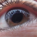 Göz Sulanması Tedavisi